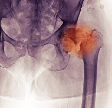 Hip Fractures Among Older Adults