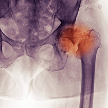Hip Fractures Among Older Adults